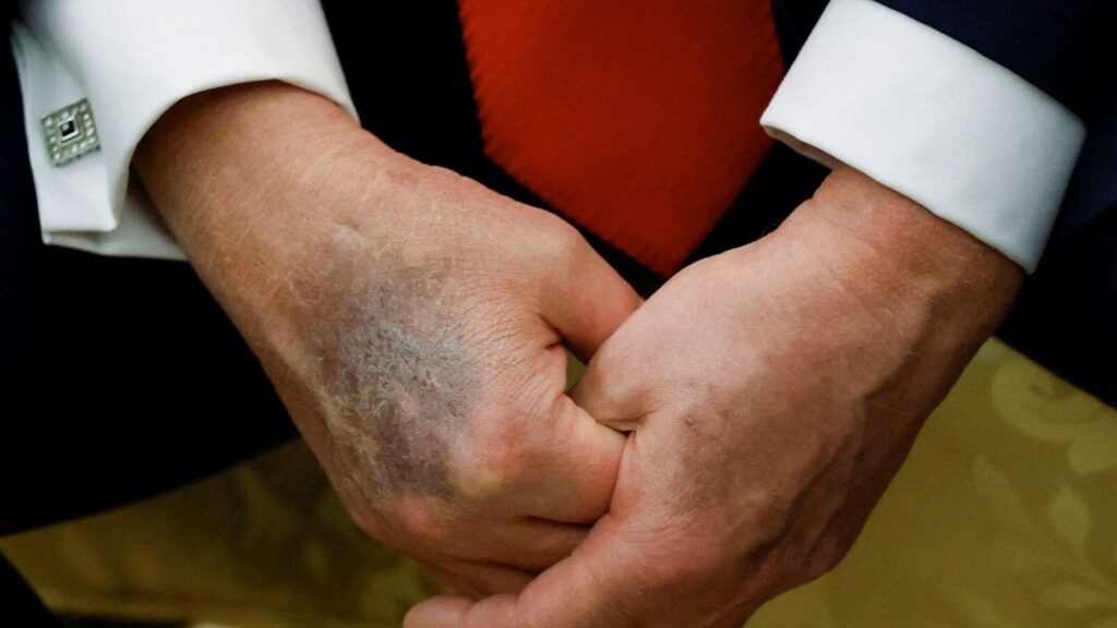 Donald Trump’s mysterious hand bruise photo goes viral again — Health speculation explodes online