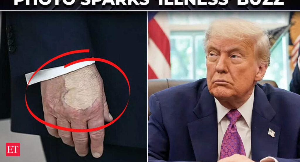 Is Trump hiding illness? Viral photos show his hand with makeup, sparking fresh health concerns - The Economic Times Video