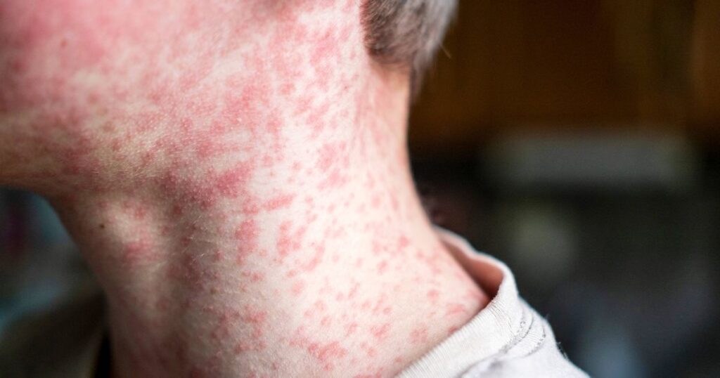 UK-wide alert issued for 'highly contagious' virus that 'starts like a cold'