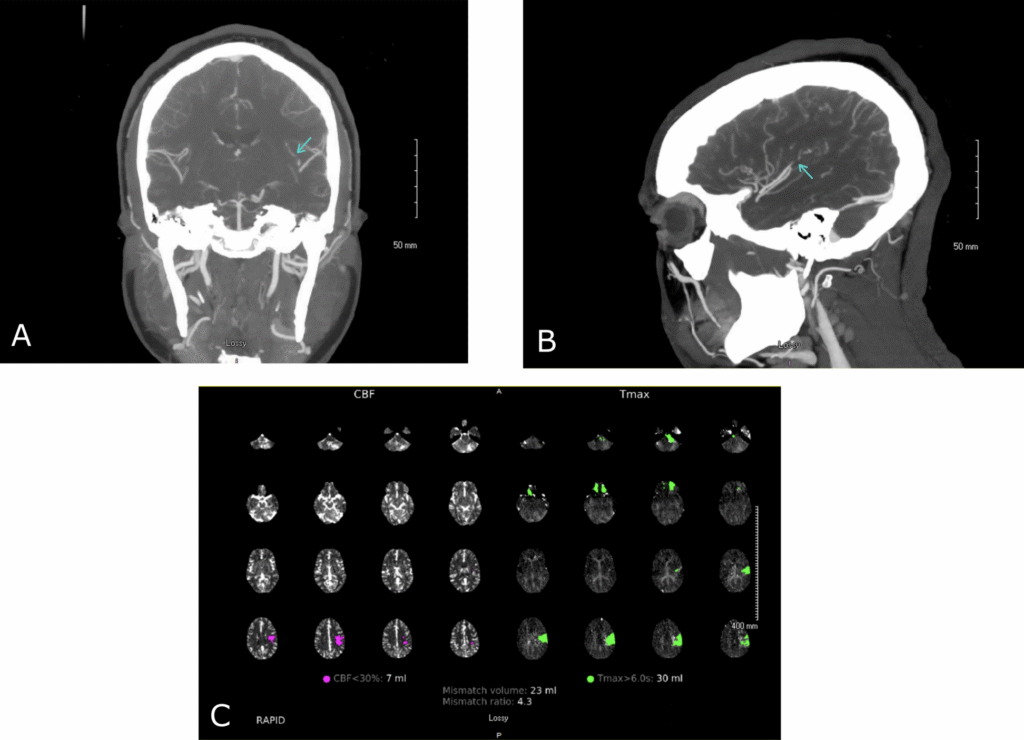 Acute ischemic stroke in a young adult in association with Epstein–Barr virus infection: a case report | Journal of Medical Case Reports