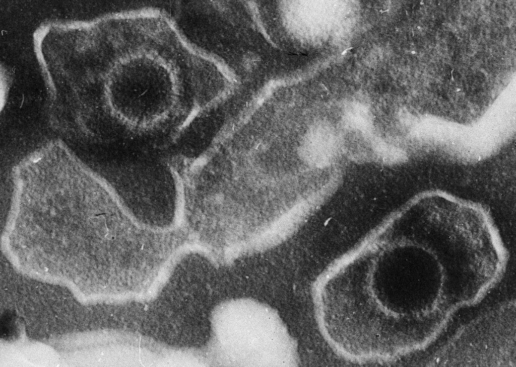 Virus found in 94% of adults could be the cause of Lupus, study finds