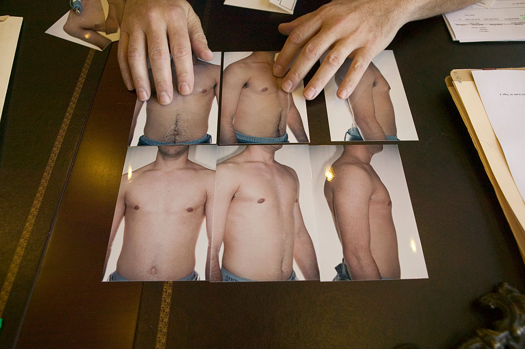 Story about male breast reduction goes viral – everyone's making the same point